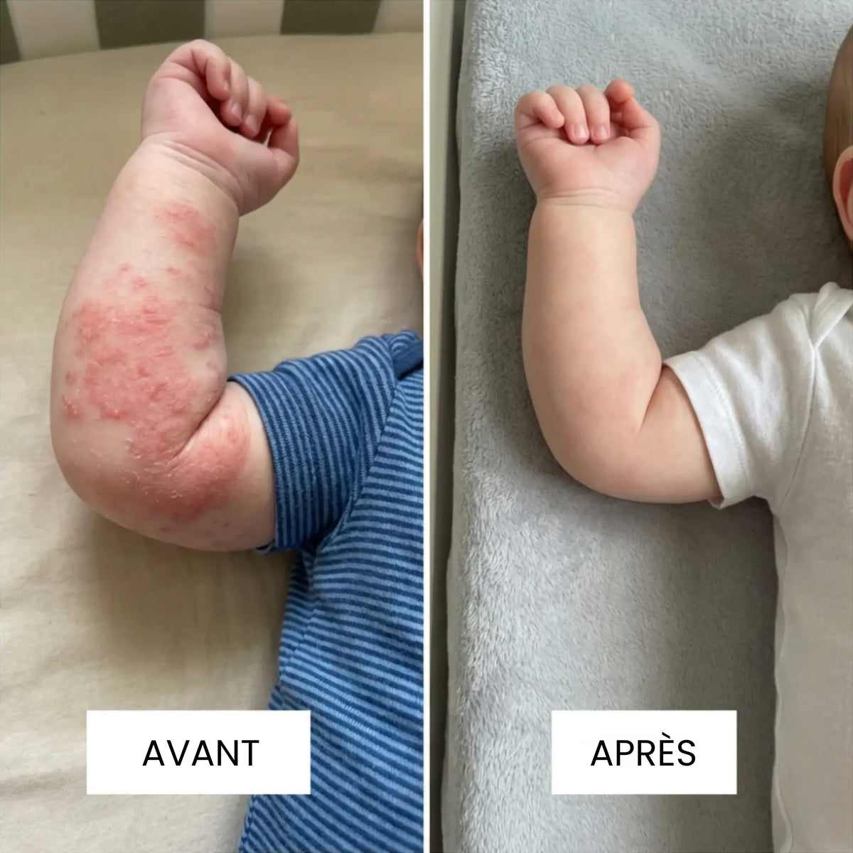Crème au Miel pour l'Eczèma