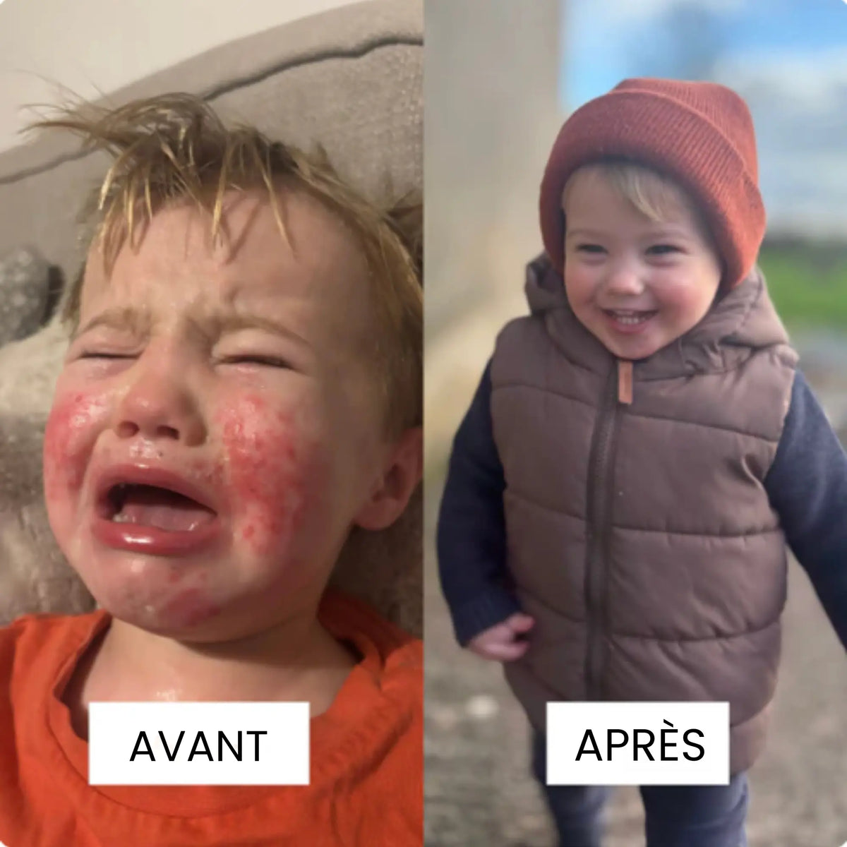 Crème au Miel pour l'Eczèma