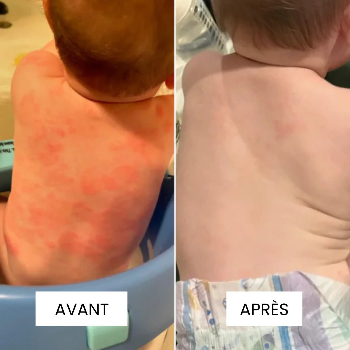 Crème au Miel pour l'Eczèma
